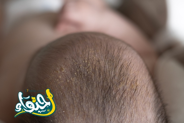 seborrheic dermatitis crusts on the baby’s head. child with seborrhea in the hair, newborn skin problems