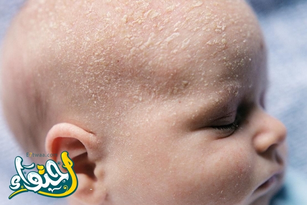 seborrheic dermatitis crusts on the baby’s head. child with seborrhea in the hair, newborn skin problems