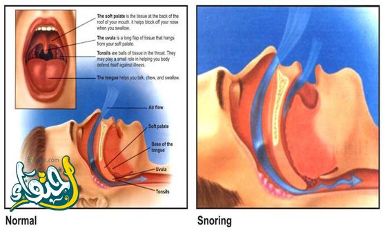 Does snoring indicate illness